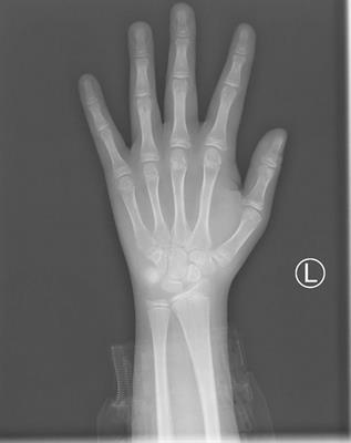 Case report: A case of Culler-Jones syndrome caused by a novel mutation of GLI2 gene and literature review